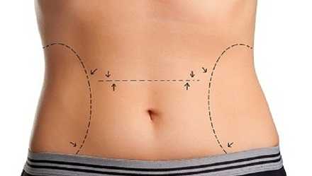 Abdominoplastie după pierderea în greutate de 43 kg cu sau fără liposucție